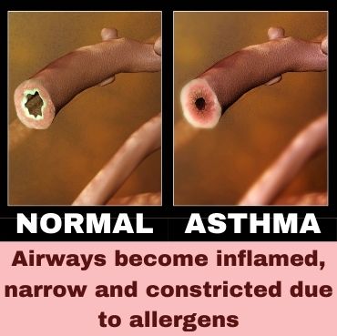 Cause of Asthma